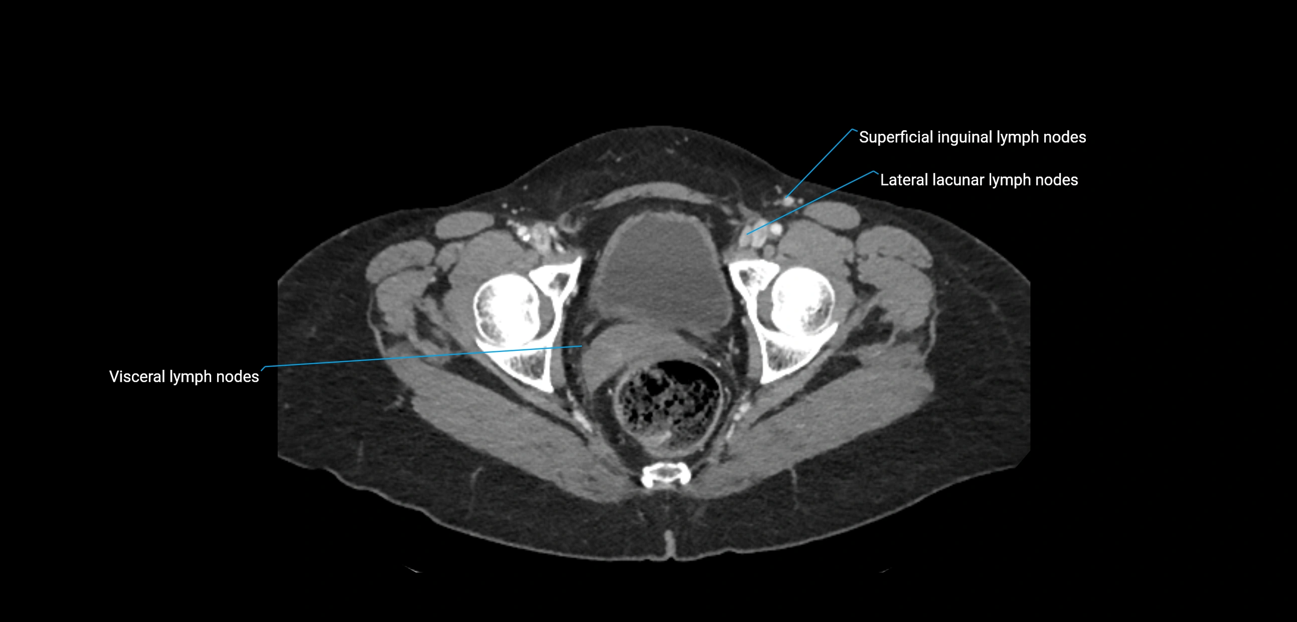 CT ct abdominal lymph nodes  axial cross sectional anatomy  enchanced radiology image -img-00002-00390.webp